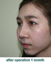 plastic_surgery_augmentation_rhinoplasty